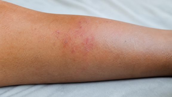 Peau du corps abîmée : identifier les causes et y remédier efficacement